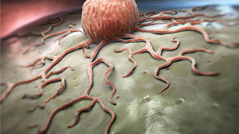 دیابت نوع دو با خطرسرطان در ارتباط است