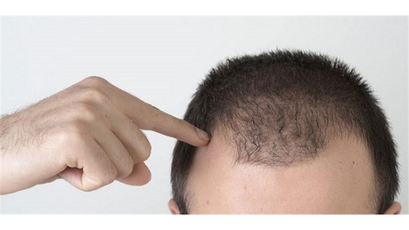 ریزش مو را چطور کنترل کنیم