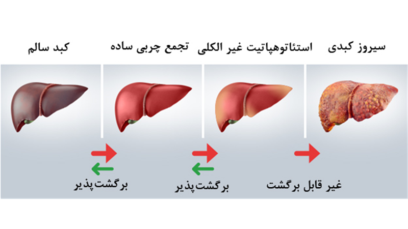 سبک زندگی را تغییر دهید کبد چرب درمان می شود