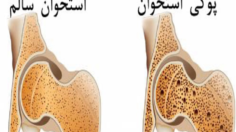 سنجش تراکم استخوان برای چه کسانی ضروری است