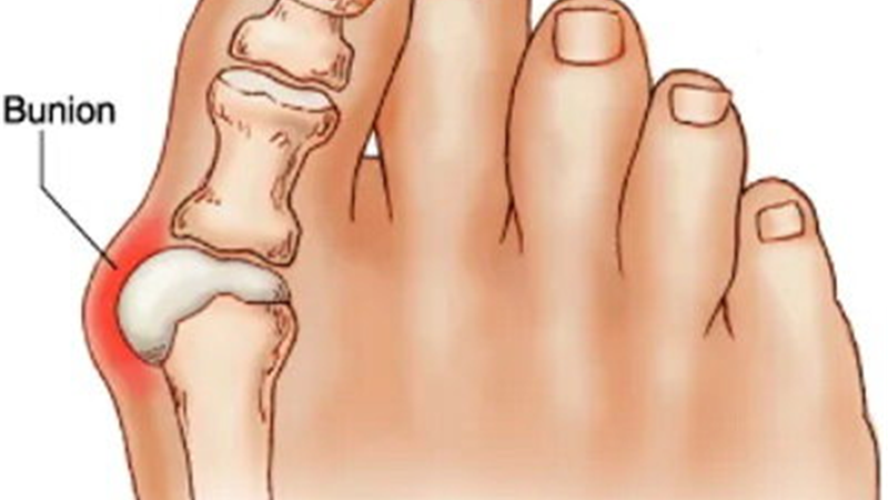 انحراف شست پا را چطور درمان کنیم