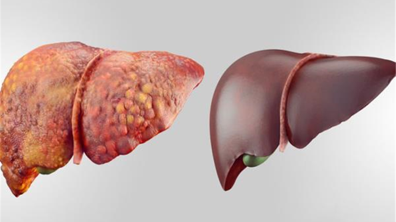 کبد در چه صورتی چرب می شود
