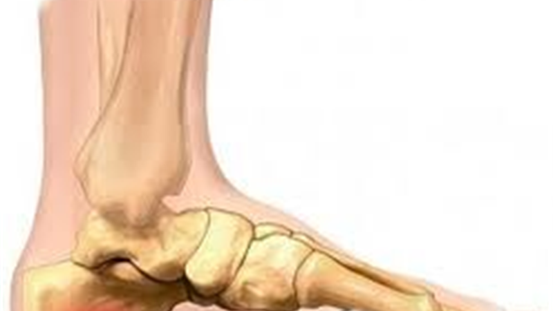 خار پاشنه در چه کسانی به وجود می آید