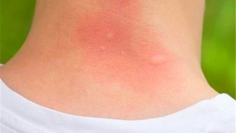 بیماری لایم  و راه درمان آن 