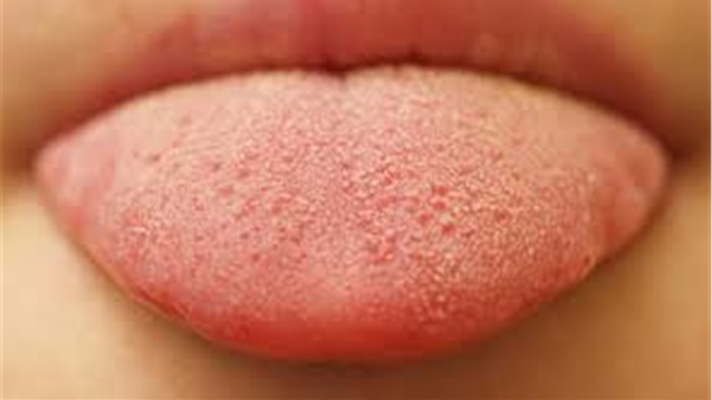 علت سفیدی زبان چیست و برای از بین بردن آن چه کنیم