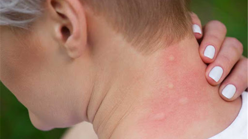 راش پوستی چیست و چطور درمان  می‌شود