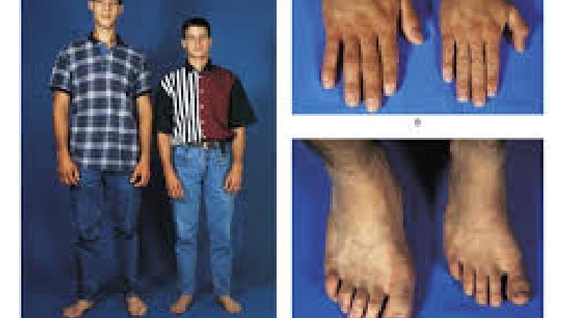 بیماری غول پیکری یا ژیگانتیسم چیست و چطور درمان می شود