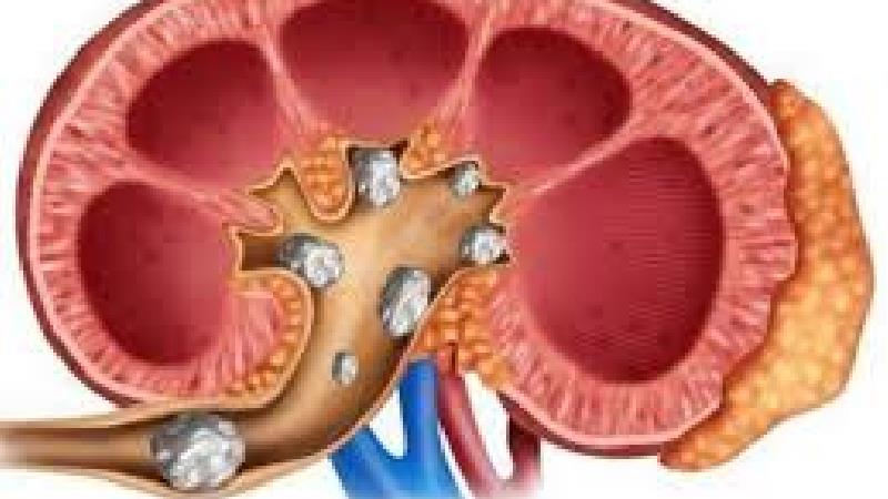 علایم سنگ کلیه چیست و چطور آن را درمان کنیم