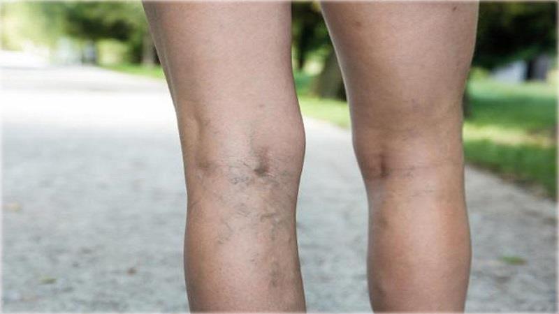 فلبیت چیست و  چطور تشخیص داده می‌شود و درمان خانگی آن چیست