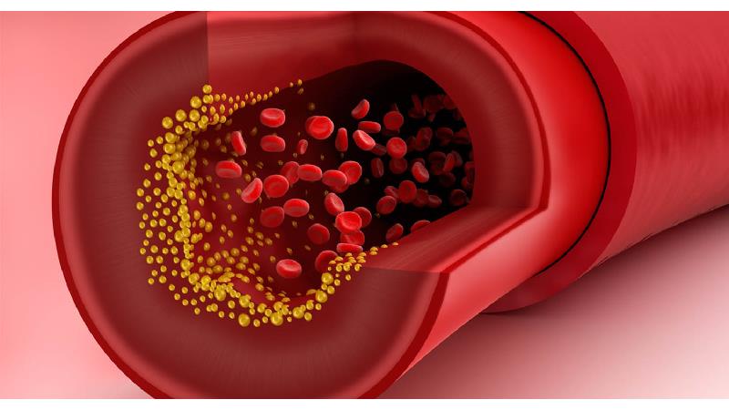 تری گلیسرید چیست ،چه عوارضی دارد و چطور درمان می‌شود