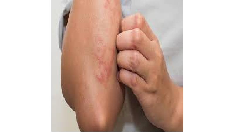 بثورات پوستی چیست و چطور درمان می شود