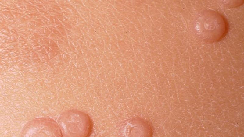 زگیل تناسلی چیست و چطور تشخیص داده می شود