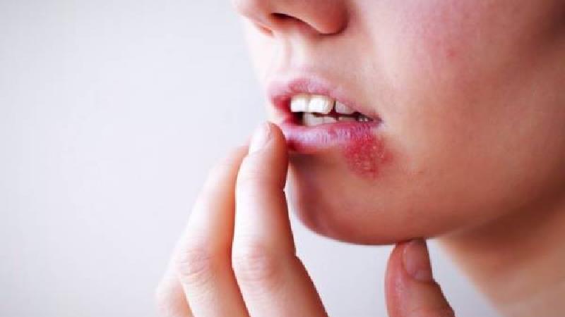 درمان سریع و خانگی تبخال چیست