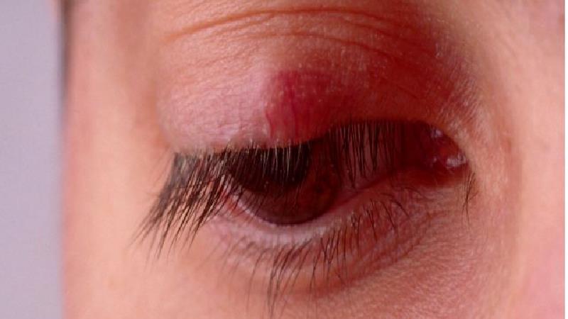 گل مژه چیست، چه علایمی دارد و چطور در خانه درمان می شود