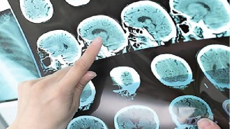 نشانه‌هایی  در بدن که می‌گوید مبتلا به ام اس هستید