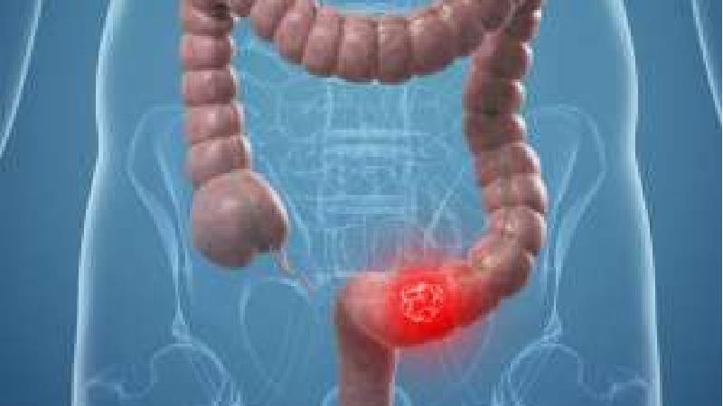 مهمترین علایم سرطان روده چیست