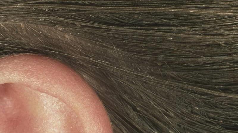 برای از بین بردن شپش سر بچه چه باید کرد