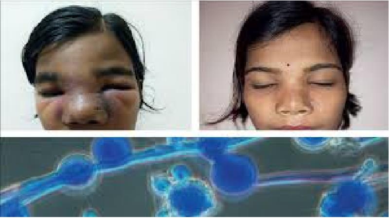 بیماری قارچ سیاه چیست  و چه علایمی دارد