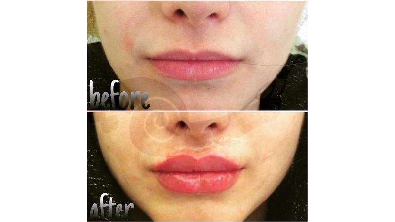 آنچه در تزریق  هیالورونیك اسید برای فرم لب باید بدانید