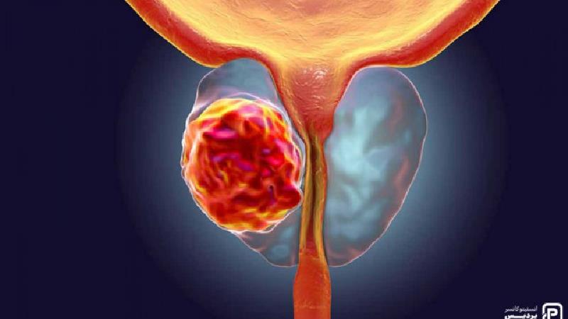 نکات مهم درباره سرطان پروستات که مردان باید بدانند