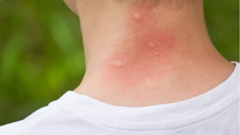 چرا پشه ها بعضی افراد را بیشتر نیش می زنند؟