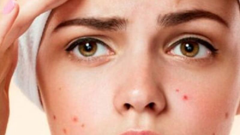 مهمترین دلایل جوش زدن هر قسمت از صورت