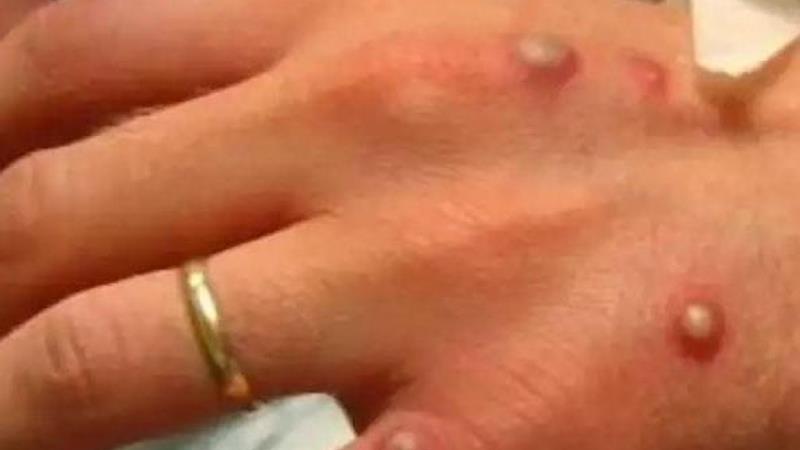 نکاتی  مهم برای پیشگیری از آبله میمونی