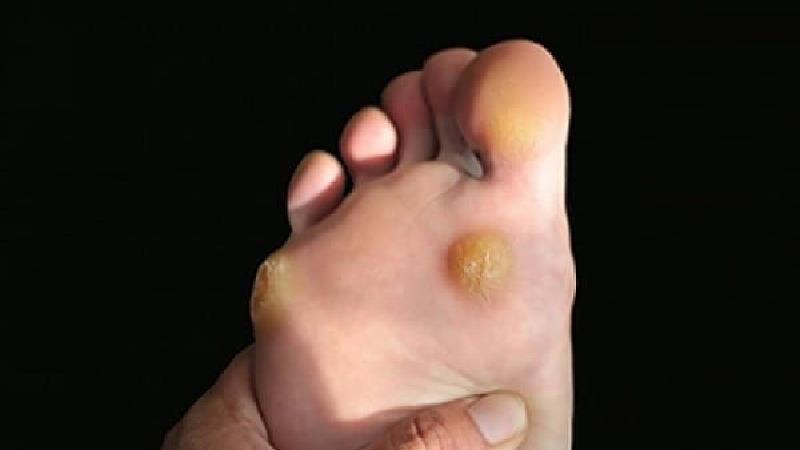 میخچه چیست و چطور درمان می شود