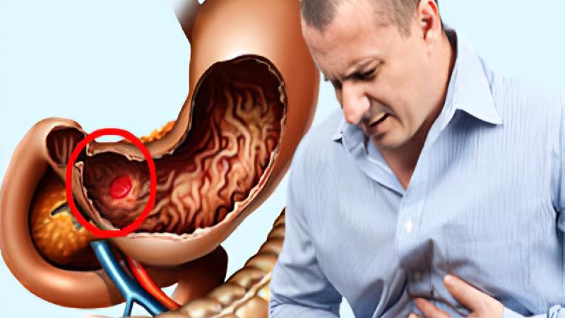 نشانه هایی که می گوید زخم معده دارید