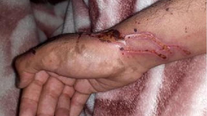 اسیدپاشی هولناک  مرد روی اعضای خانواده اش ؛ جمجمه پسر سوراخ شد