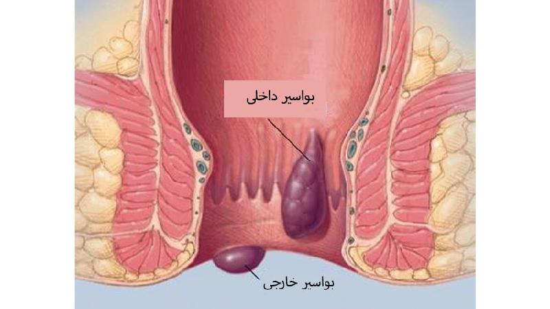 مهمترین علایم هموروئید و راه درمان آن