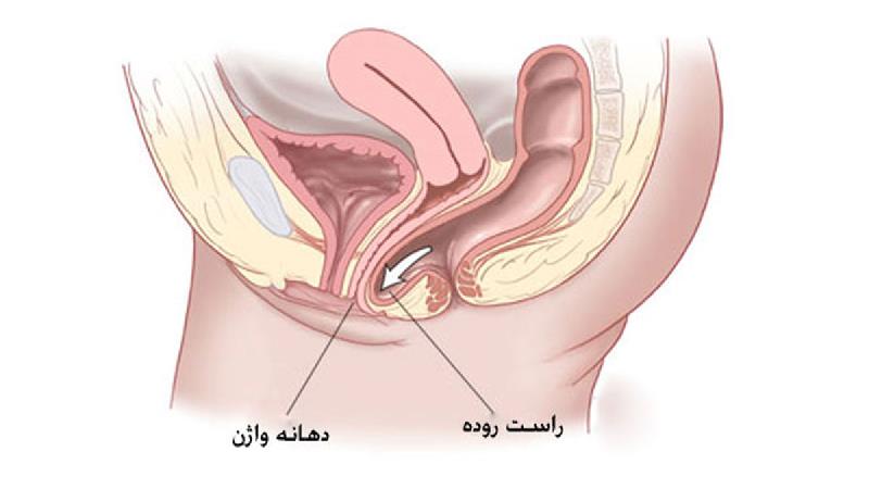 برای درمان عفونت واژن چی خوب است
