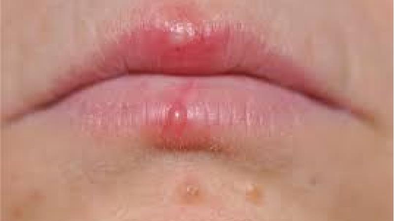 بهترین روش سریع درمان تبخال