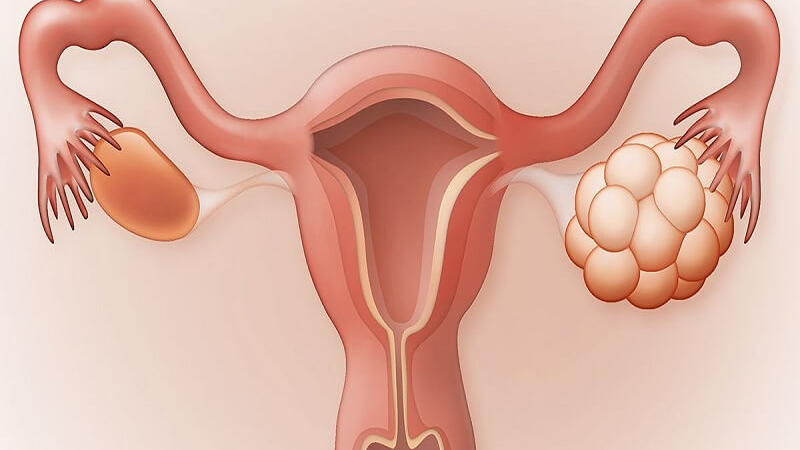 سندمر تخمدان پلی کیستیک 