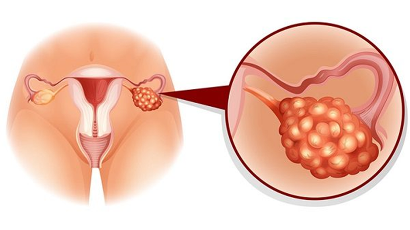 نشانه های تخمدان پلی کیستیک 