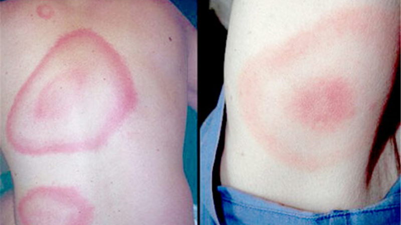 بیماری لایم چیست