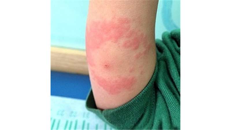 درمان بیماری لایم