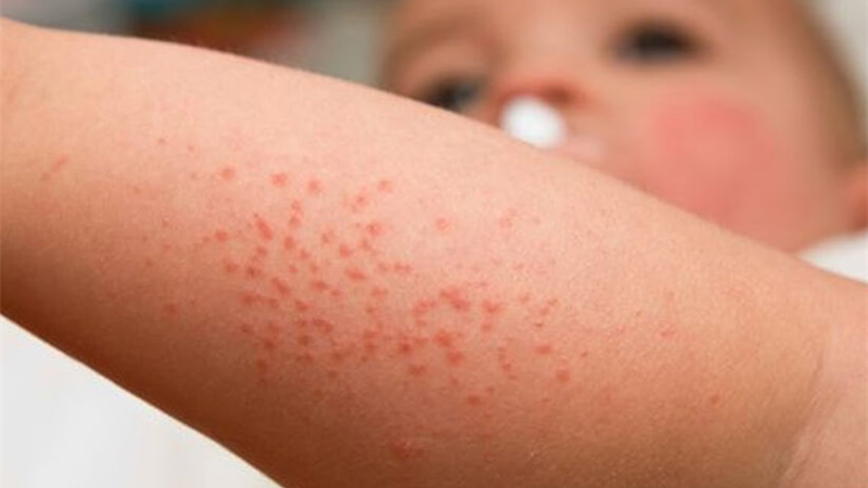 راش پوستی چیست