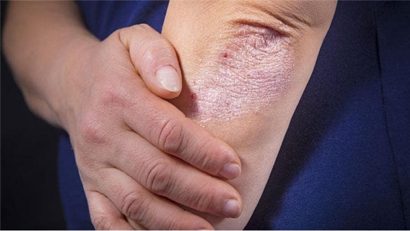 انواع راش پوستی