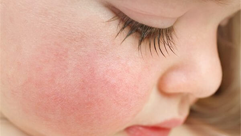 راش پوستی چیست