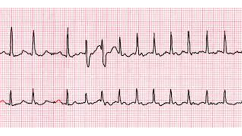 درمان ضربان نامنظم قلب