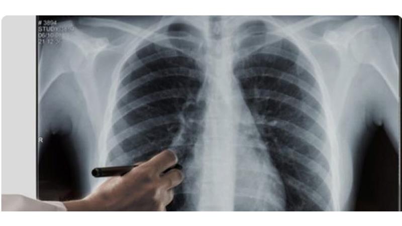 تشخیص کرونا با اسکن ریه