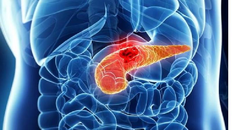 علایم سرطان پانکراس