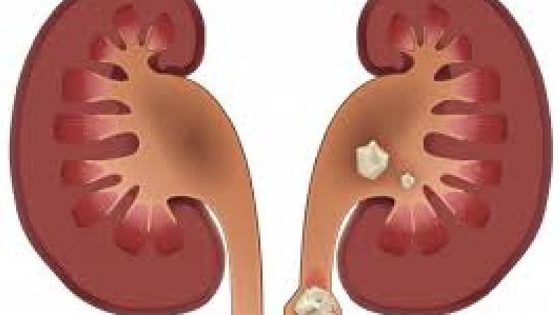 سنگ کلیه چطور به وجود می آید