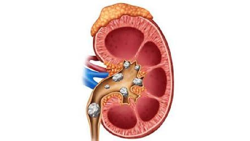 سنگ کلیه چیست