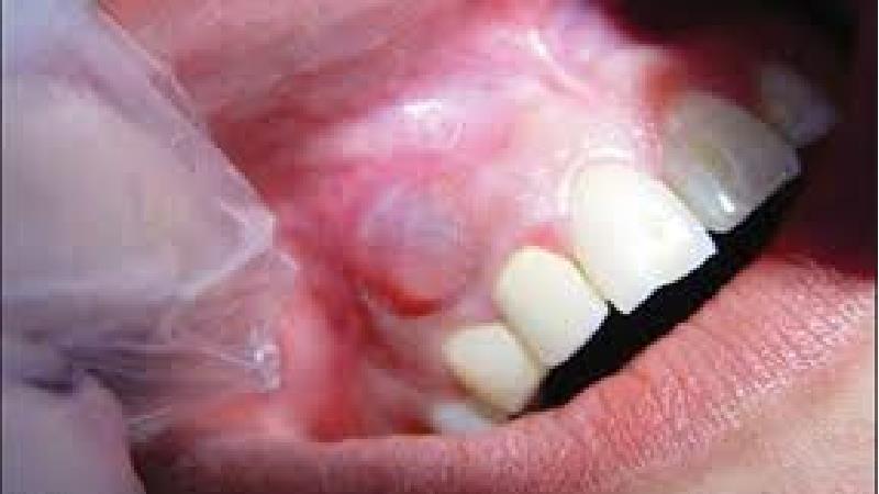 کیست دندان چیست