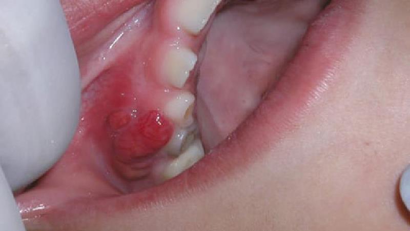 درمان خانگی کیست دندان