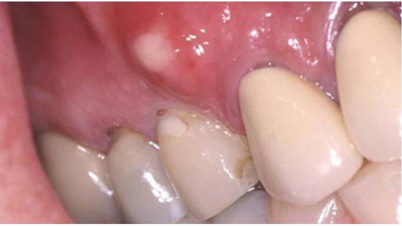 درمان کیست دندان