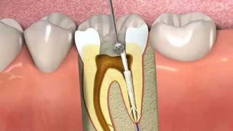 آبسه در دندان