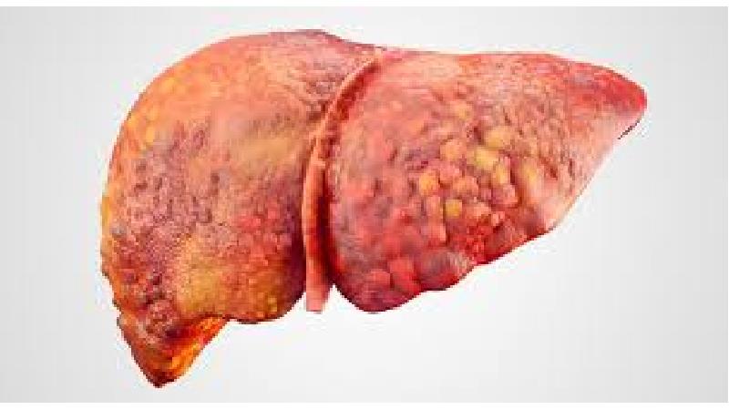 درمان کبد چرب